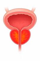 Prostatos liaukos uždegimas